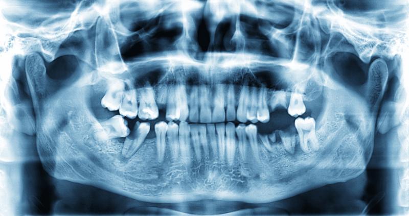 Ząb Zatrzymany Przyczyny I Objawy Es Dentica 5677